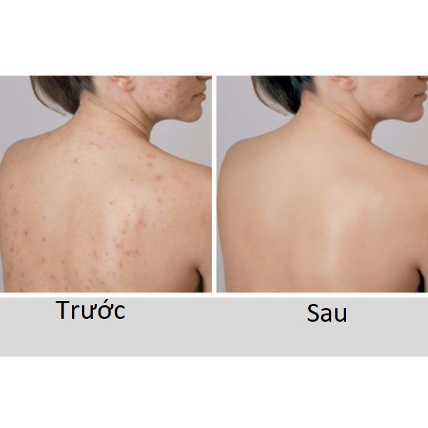 Xà phòng giảm mụn lưng Than tre hoạt tính Ogatic Soap, xà bông tắm dưỡng da mềm mịn, giảm thâm mụn, phù hợp mọi loại da | BigBuy360 - bigbuy360.vn