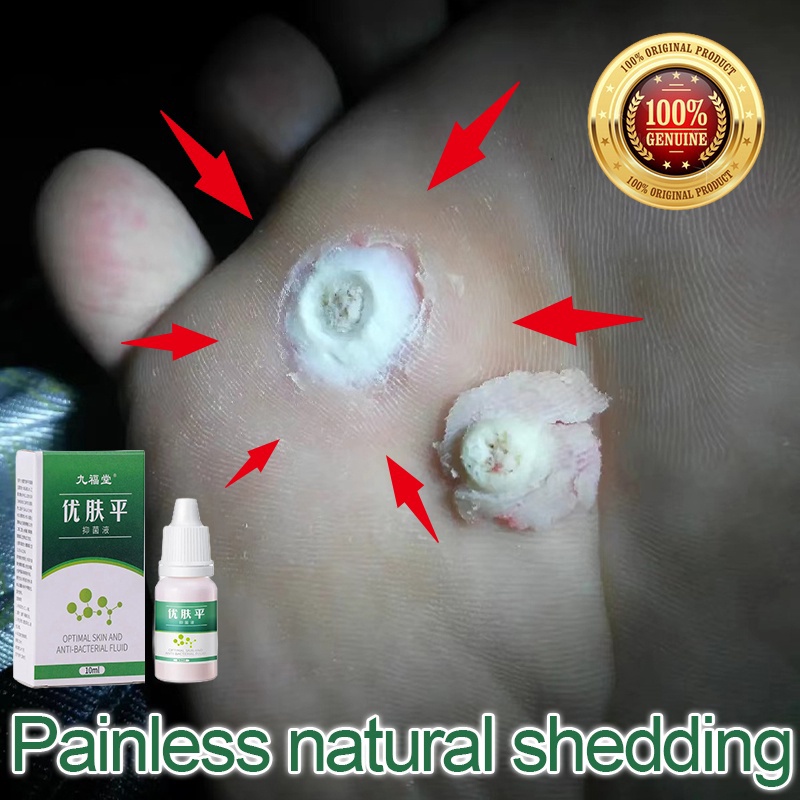 Kem Mụn Cóc Chết Xuất Thảo Mộc Ức Chế Vi Khuẩn Loại Bỏ Mụn Thịt Mụn Cơm Hết Nấm Cải Thiện Móng Thay Màu Nứt Móng