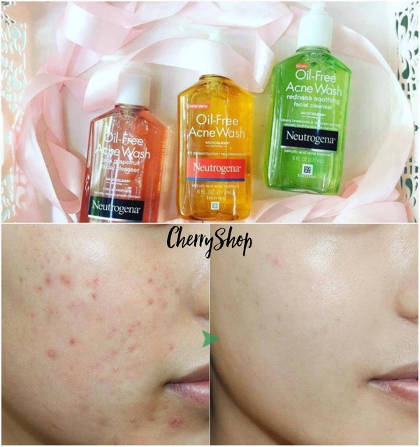 [Hàng USA] Sửa Rửa Mặt Gel Làm Sạch Và Ngăn Ngừa Mụn Neutrogena Oil-Free Acne Wash (177ml) | BigBuy360 - bigbuy360.vn