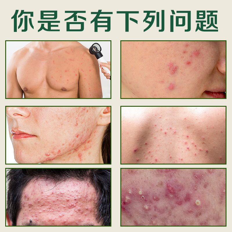 (Hàng Mới Về) Bộ Sản Phẩm Trị Mụn Đầu Đen Liposomes