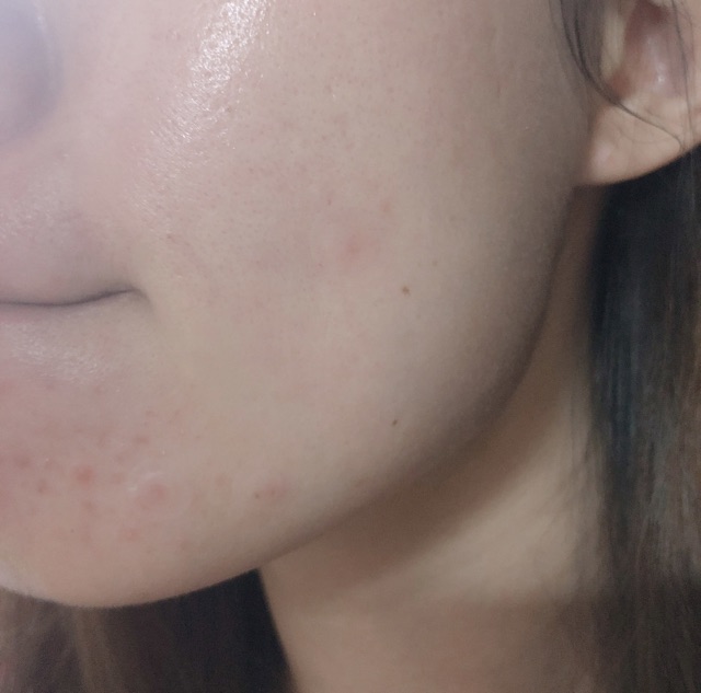 MIẾNG DÁN MỤN CAREPLUS OLIVE YOUNG