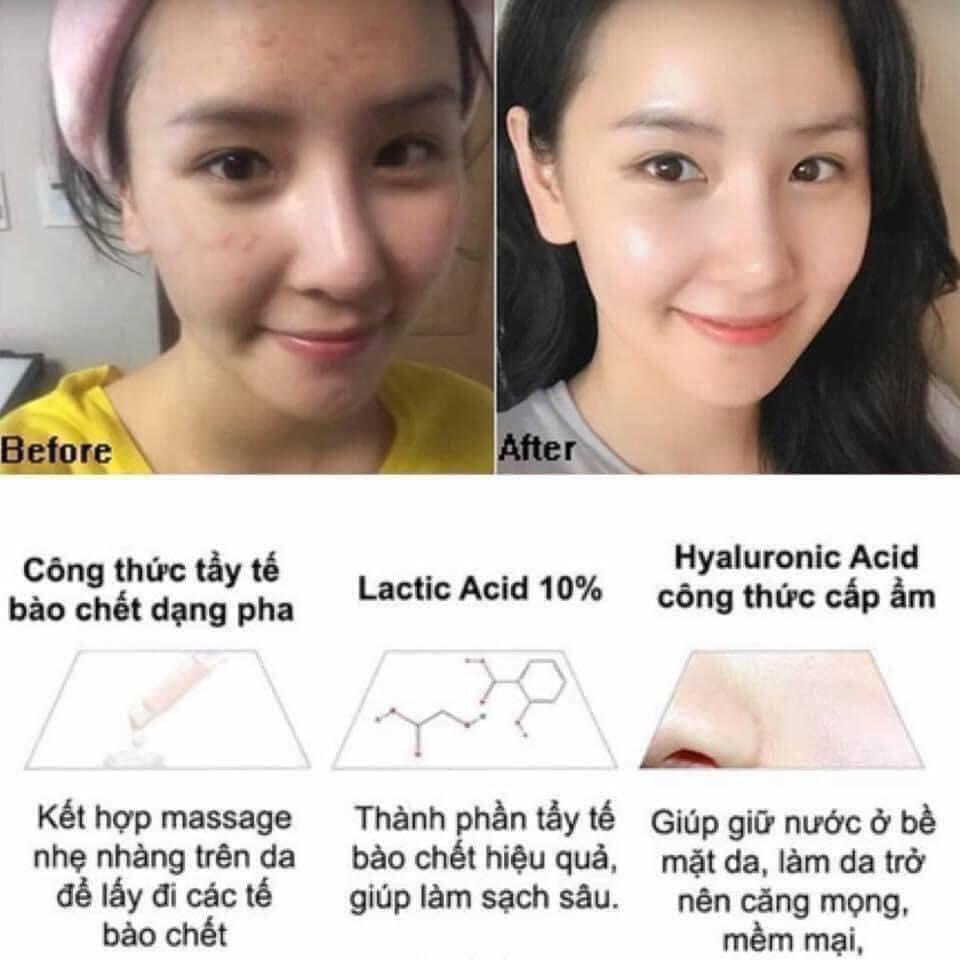 [Bill Us] The Ordinary Tẩy Da Chết Mụn Đầu Đen Tinh Chất Lactic Acid