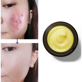 KEM MỤN CÀ RỐT