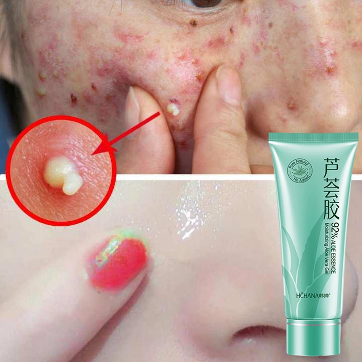 Gel nha đam Dưỡng ẩm Chống lão hoá Trị mụn trứng cá Mờ sẹo Gel chống nắng 40g Dịu nhẹ không kích ứng