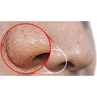 Cây nặn mụn đầu đen 2 đầu