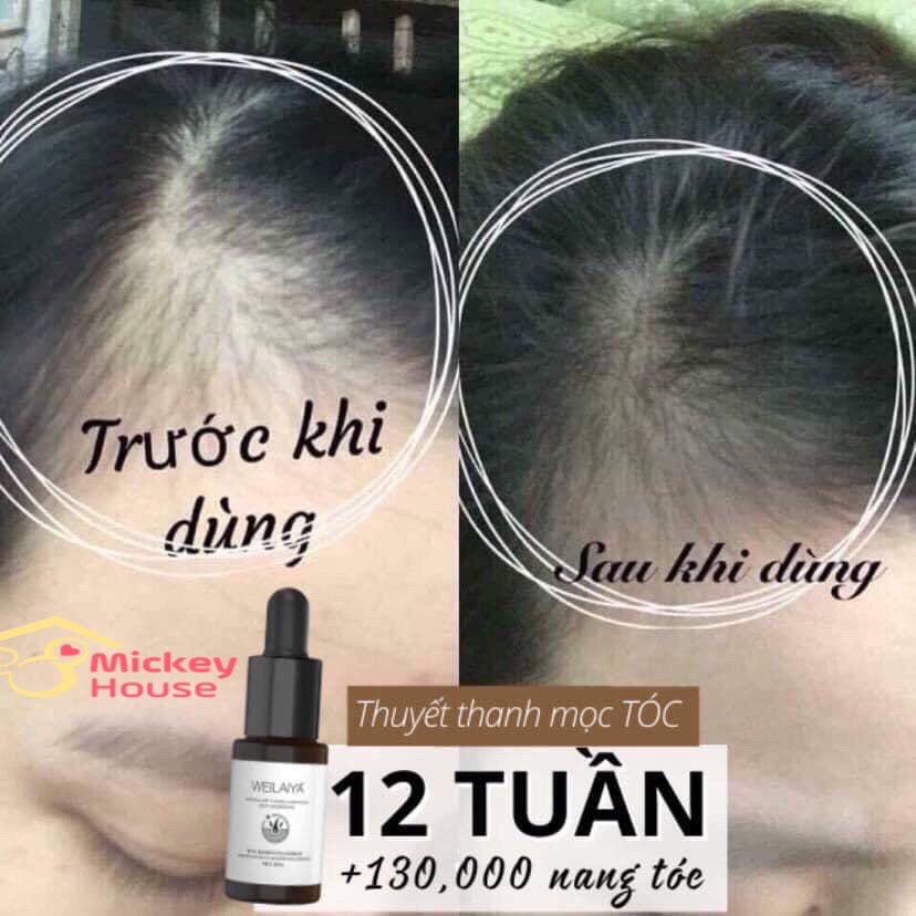 Serum Huyết Thanh Tóc WEILAIYA, Kích Mọc Tóc, Ngăn Ngừa Rụng Tóc, Hiệu Quả Sau 12 Tuần Sử Dụng [ HỘP 8 LỌ - CHÍNH HÃNG ]