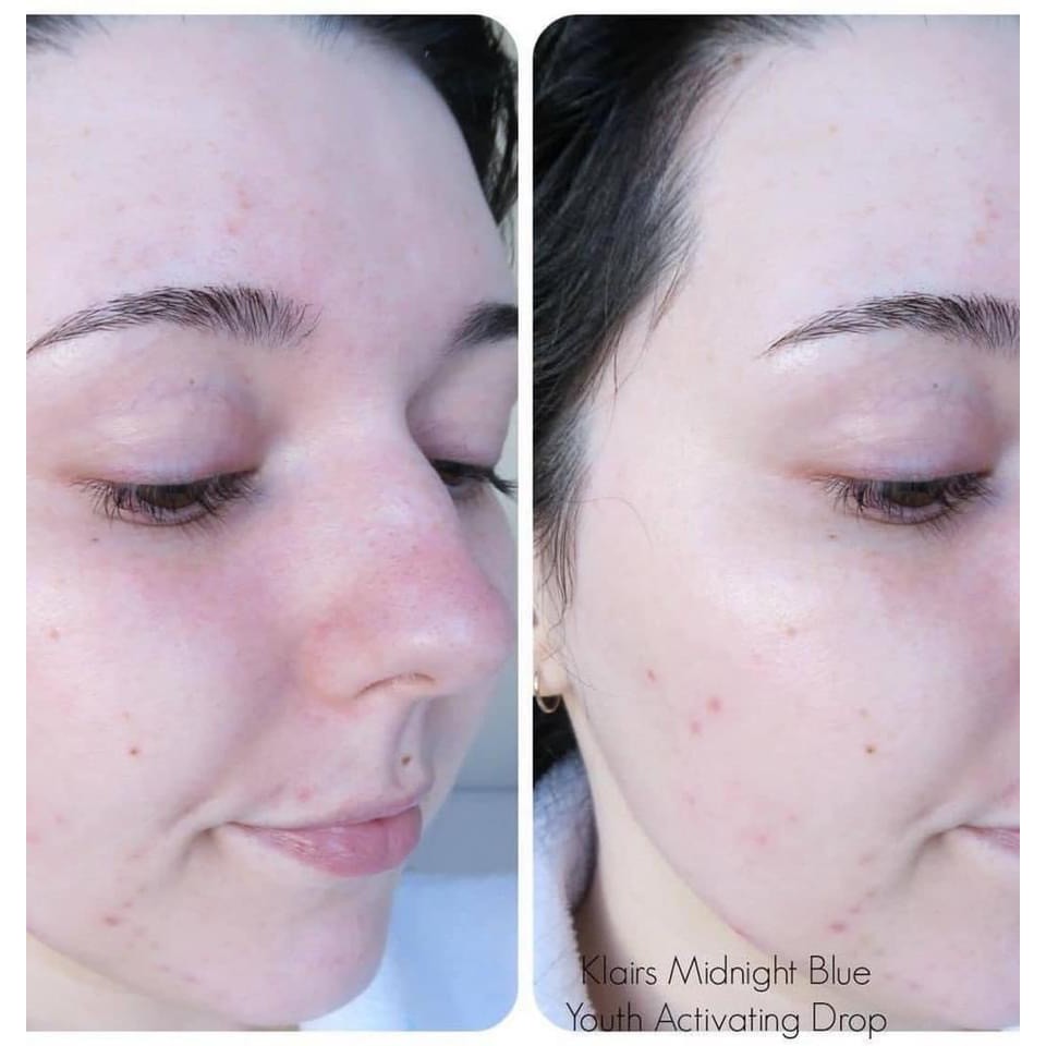 Serum Phục Hồi Da Dầu Mụn Nhạy Cảm Klairs Midnight Blue 20ml | BigBuy360 - bigbuy360.vn