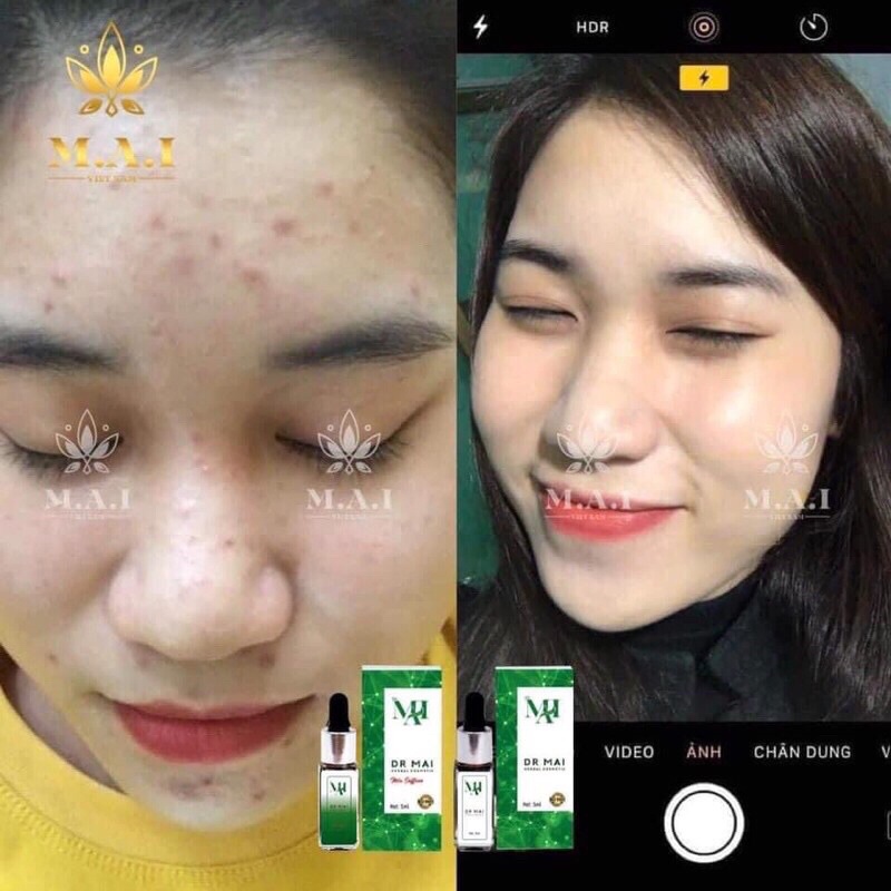 Combo nguyen chat mix tri mun tham chinh hang 💯.