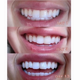 Dán trắng răng CREST 3D WHITE PROFESSIONAL EFFECT WHITESTRIPS