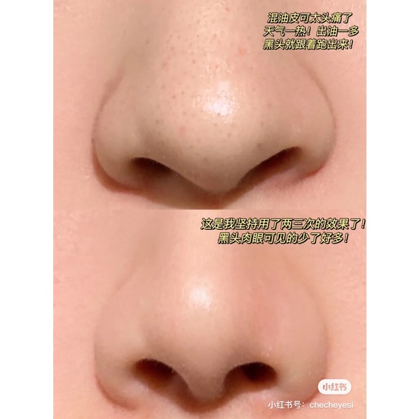 Miếng Dán Lột Mụn Ciracle Good-bye Blackhead