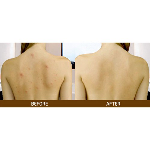 Sữa Tắm Aderma Giảm Mụn Lưng, Viêm Lỗ Chân Lông 500ml - DUXBO