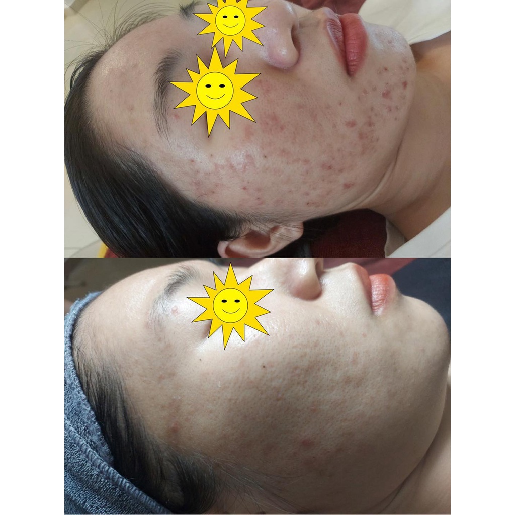 Serum Vitamin A Cho Da Mụn Thâm - Hương Chất Cosmetic
