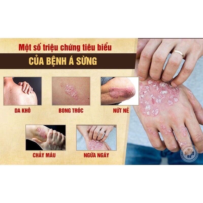 Kem bôi ngứa, hắc lào, vảy nến, á sừng, nứt chân, nấm