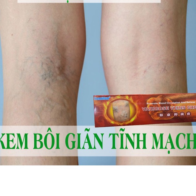 [HOT] Kem bôi giãn tĩnh mạch Sumifun hiệu quả cao