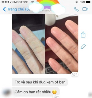 KEM CHỐNG NẺ GLYSOLID 100ml