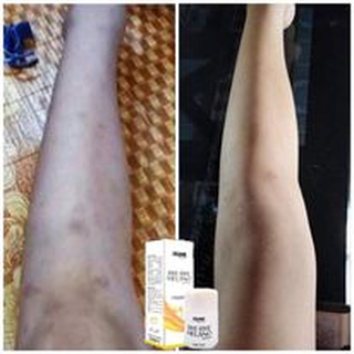 Serum Thâm Jiuhe 5ml