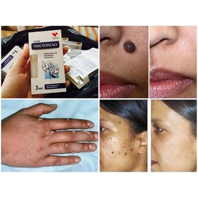 Gel tẩy nốt ruồi, mụn cóc, mụn thịt, sẹo lồi  Dvelinil của Nga | BigBuy360 - bigbuy360.vn