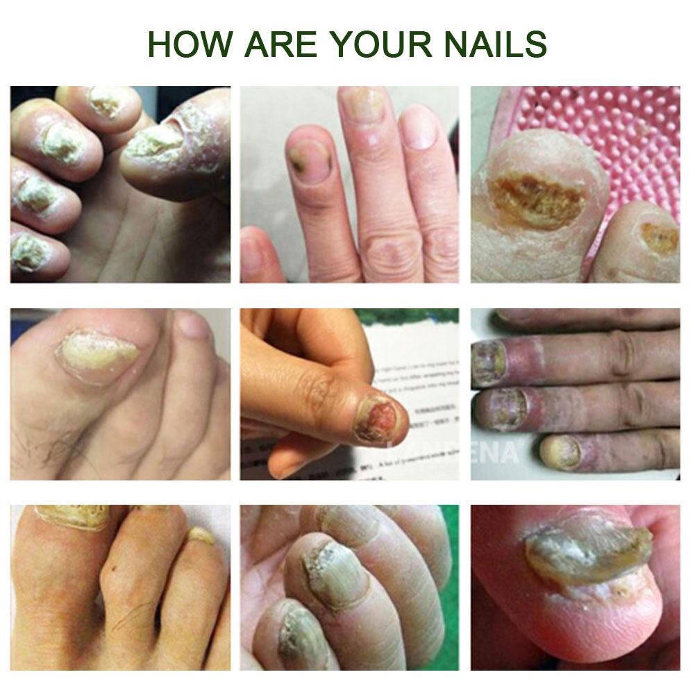 Tinh chất loại bỏ nấm móng tay tự nhiên dạng lỏng chăm sóc tiện lợi 10ml