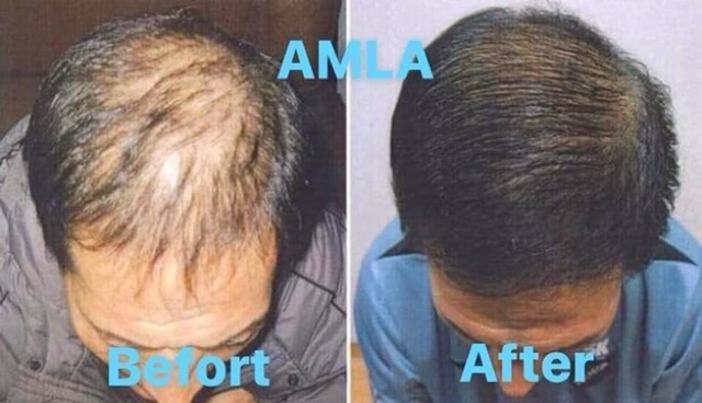 Dầu gội đầu AMLA trị rụng tóc, giảm ngứa da đầu, trị gàu