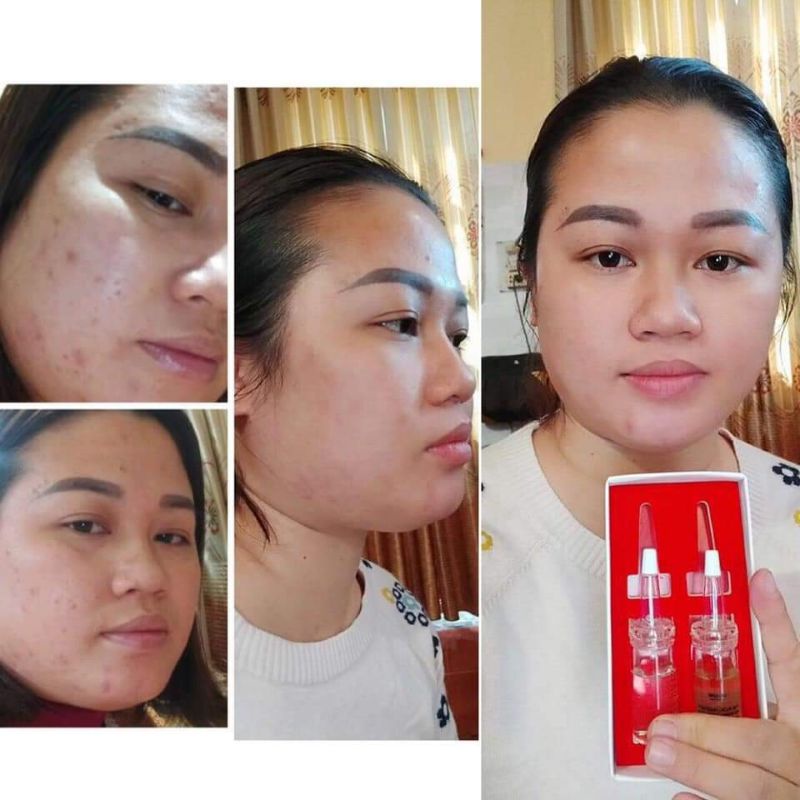 Serum đánh bay mụn 11day Linh Hương | BigBuy360 - bigbuy360.vn