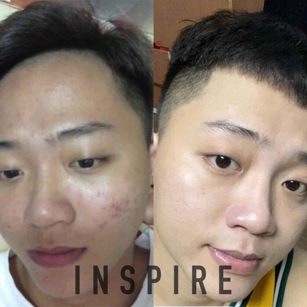 Serum Ngừa Mụn INSPIRE Acne Serum Sạch Mụn, Sáng Da 15ml