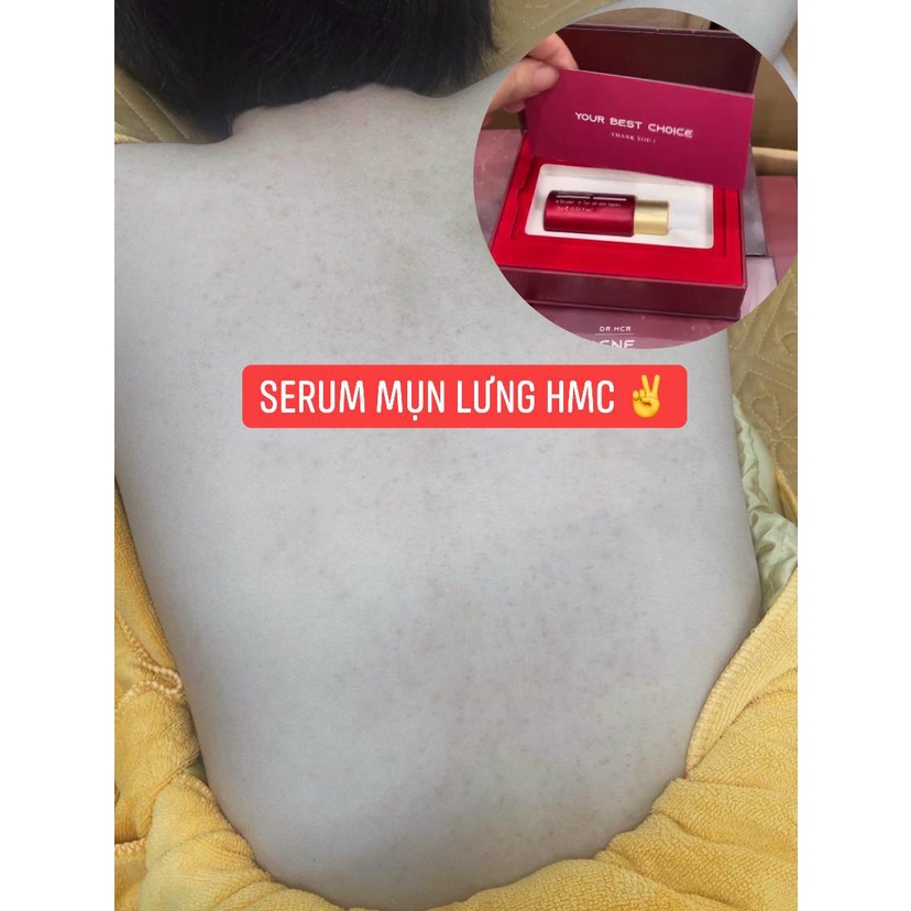 Serum giảm mụn lưng, mụn ,mặt,  nang lông 10ML N'Cell Anti Acne - Tinh chất mờ thâm nám Bright serum N'cell