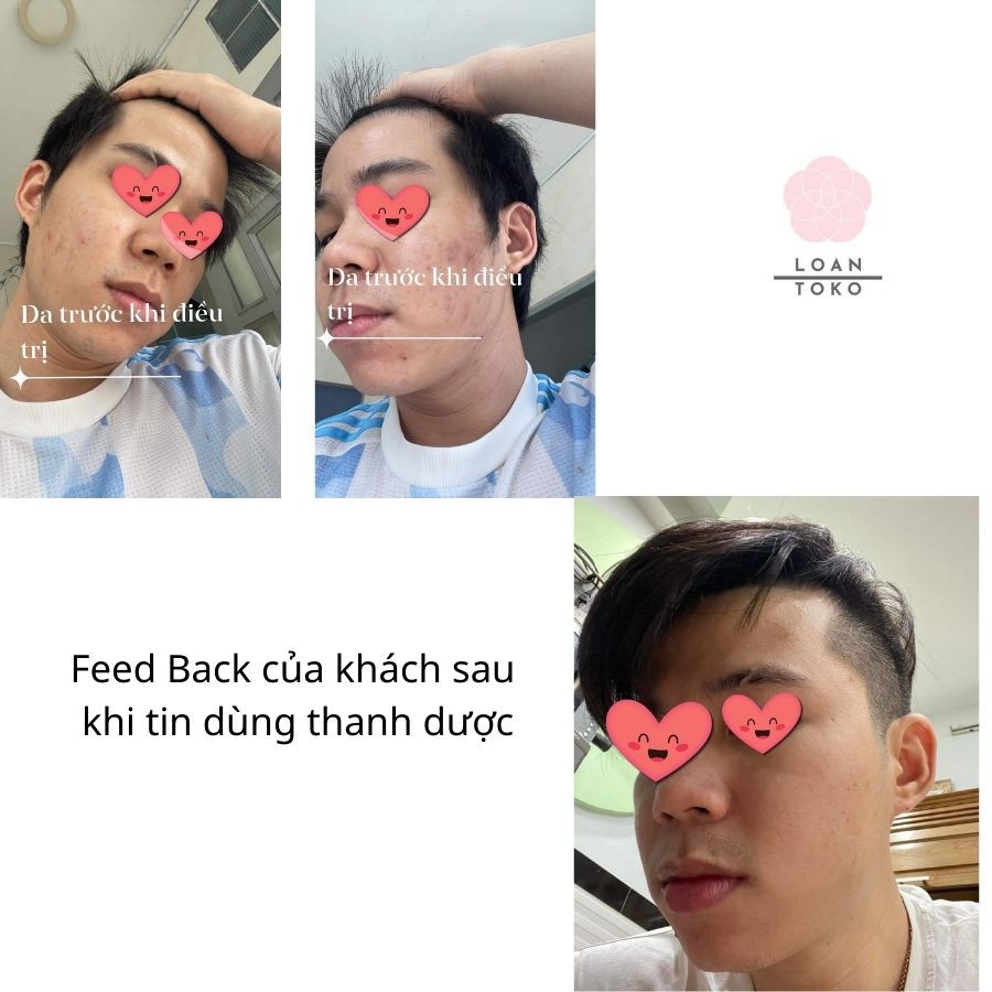 Thanh dược Skincare cho da mụn ,rỗ,nám, tàn nhang,tái tạo mờ thâm da chiết xuất từ thiên nhiên 80ml | BigBuy360 - bigbuy360.vn