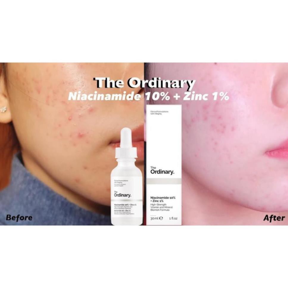 Tinh Chất Dưỡng Da / Serum Ngừa Mụn GiảmThâm Niacinamide 10% + Zinc 1% The Ordinary [Cam kết hàng Auth]