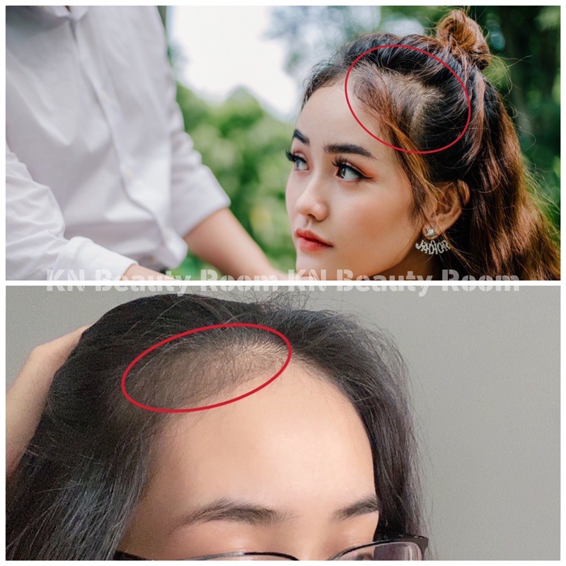 Xịt Tinh Chất Kích Mọc Tóc Giảm Rụng Trị Hói- KN Beauty Room | BigBuy360 - bigbuy360.vn