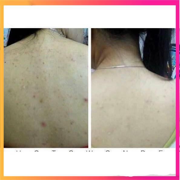 Muối tắmFreeshipMuối tắm loại bỏ mụn lưng nang lông massage dưỡng nhan Doctor Beauty