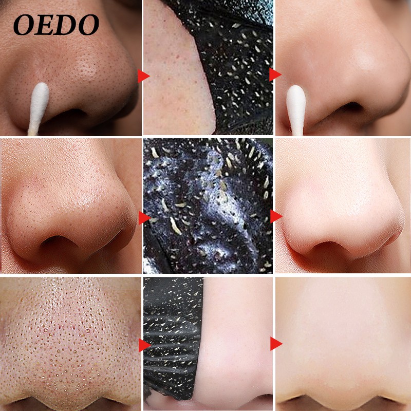Loại bỏ mụn đầu đen miếng vá mũi OEDO kiểm soát dầu và làm sạch sâu da Bỏ Mụn Làm Sạch Lỗ Chân 1g