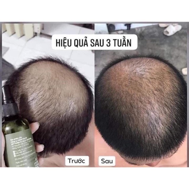 Tinh dầu bưởi Vijully giúp mọc tóc nhanh, dành cho người hay rụng tóc xịt là mọc | BigBuy360 - bigbuy360.vn