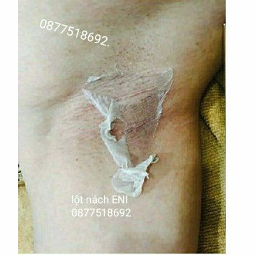 Peel Lột Nách Hết Thâm Sạm Trắng Da