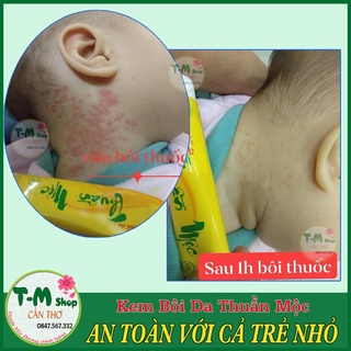 KEM BÔI DA LIỄU