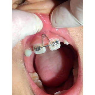 Loop đóng khoảng răng cửa