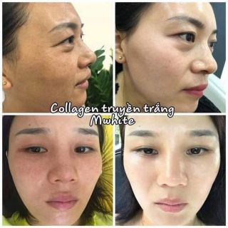 TRUYỀN TRẮNG COLLAGEN FACE MWHITE