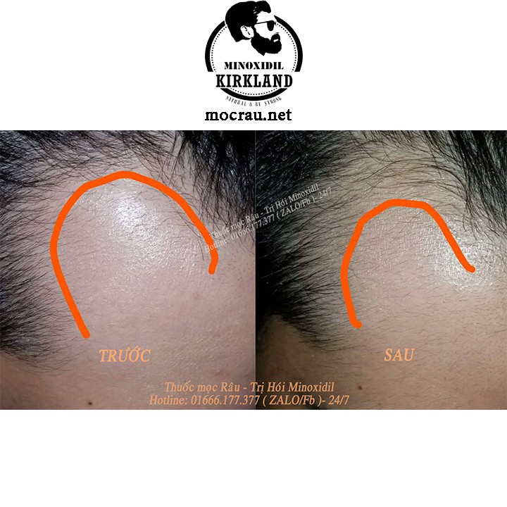 COMBO 2 lọ Thuốc Mọc Râu Minoxidil Kirkland + Tặng ống Bơm và Áo - Trị Hói mọc Râu- Dưỡng rậm Chân Mày.