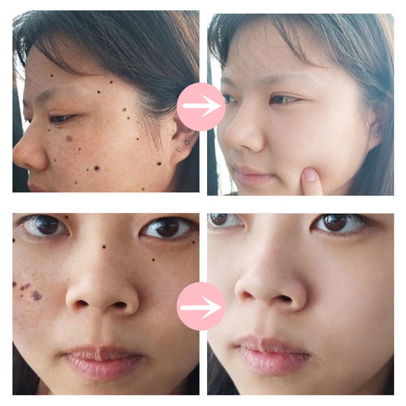 Kem tẩy nốt ruồi, loại bỏ mụn cơm mụn cóc, nốt ruồi trên mặt/ tàn nhang/ mụn cơm/ đốm đen hắc tố, không để lại sẹo