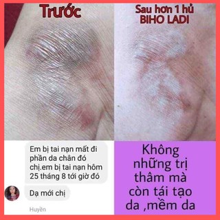 [CHÍNH HÃNG] SIÊU DƯỠNG THÂM 5S BIHO LADI