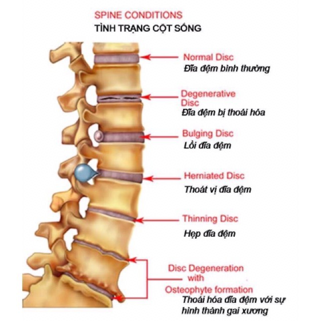 Sâm Hoàng Diệu - Viên Thoái Hoá Đốt Sống Cổ Hàn Quốc