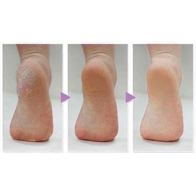 Máy Mài Gót Chân Medisana CR870 [Hàng Đức]