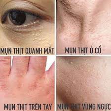 (Chính Hãng) Kem Giảm Mụn Thịt Giảm Quầng Thâm Nếp Nhăn Quanh Mắt