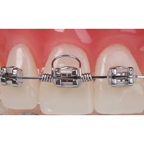 Torque chỉnh nha - Lò xo torque chỉnh nha