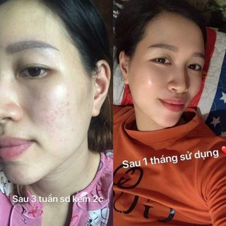 combo 5 hộp face mụn( mua 10hộp tặng 1 hộp)