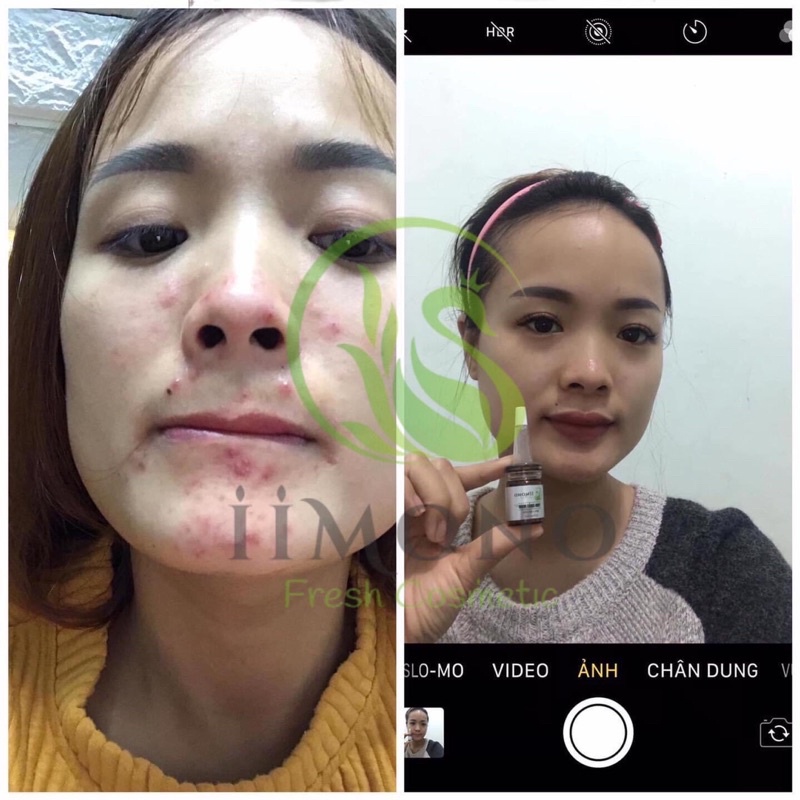Tinh chất mụn IIMONO 6ml | BigBuy360 - bigbuy360.vn