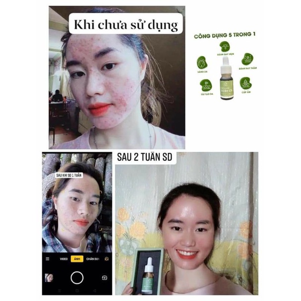 Serum Diếp Cá GIẢM MỤN, GIẢM THÂM, SE KHÍT LỖ CHÂN LÔNG, SÁNG DA - Serum Diếp Cá IGREEN | BigBuy360 - bigbuy360.vn