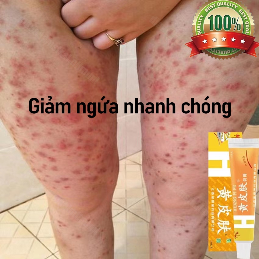 Kem loại bỏ viêm da Eczema kem Eczema loại bỏ viêm da vảy nến kháng khuẩn giảm ngứa kháng nấm nổi mề đay kem vảy nến