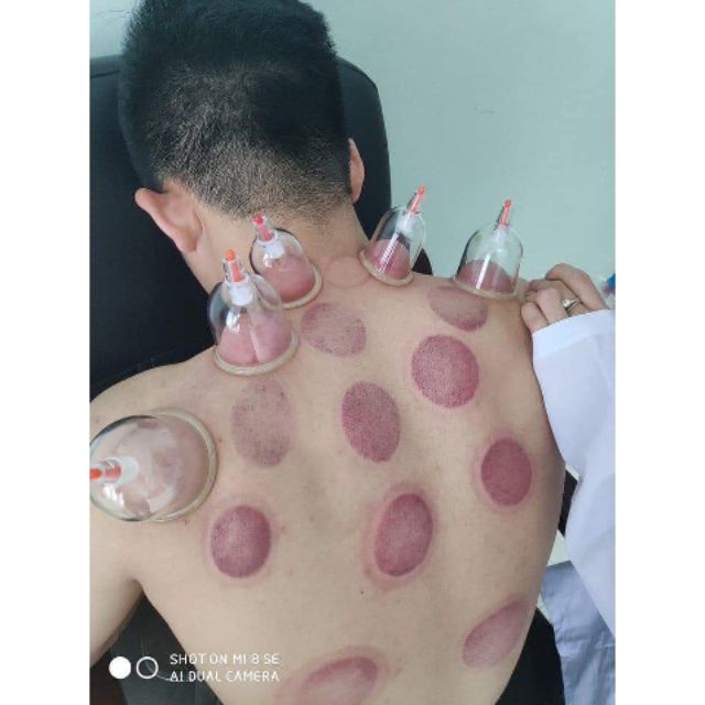Bộ giác hơi không dùng lửa 24 cốc đủ phụ kiện