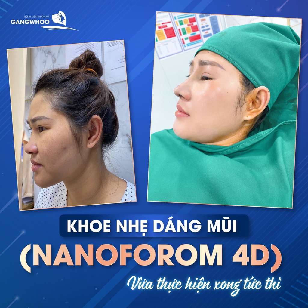 Dịch vụ nâng mũi nanoform 3D/4D/6D tại Gangwhoo