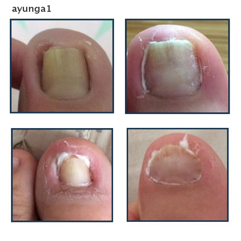 [ayunga1] Nail Art Ingrown Toe Nail Correction Tool Toenail Nail Orthosis Paronychia Clip [new]